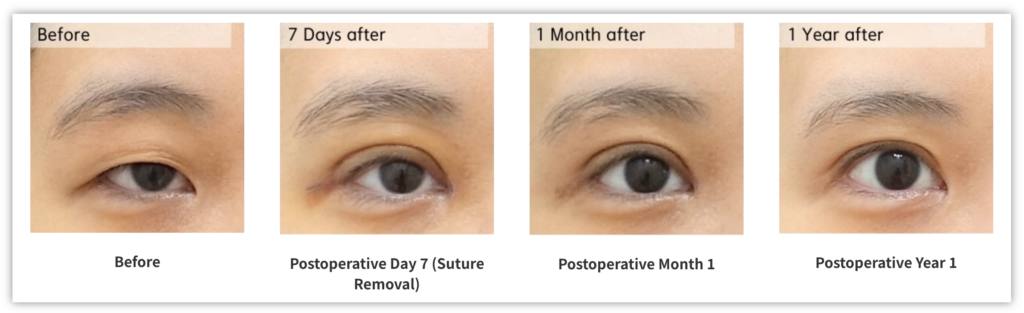 ptosis correction before after 1 year stable result