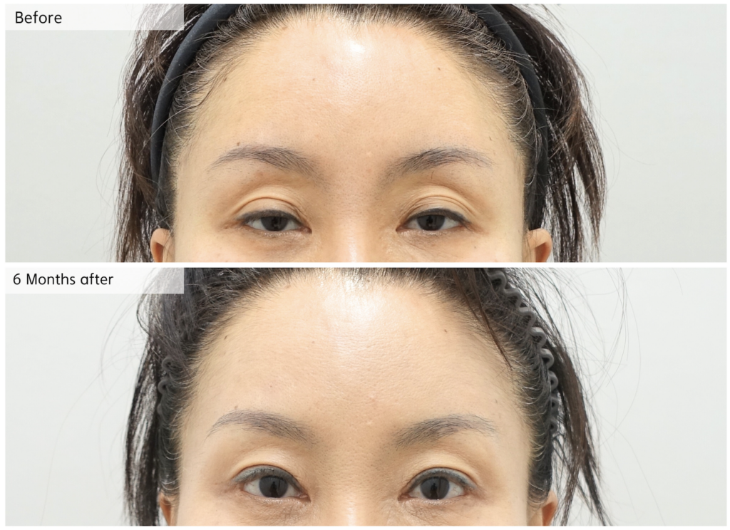 Ptosis Correction Before and After 6 Months – Natural and Stable Result