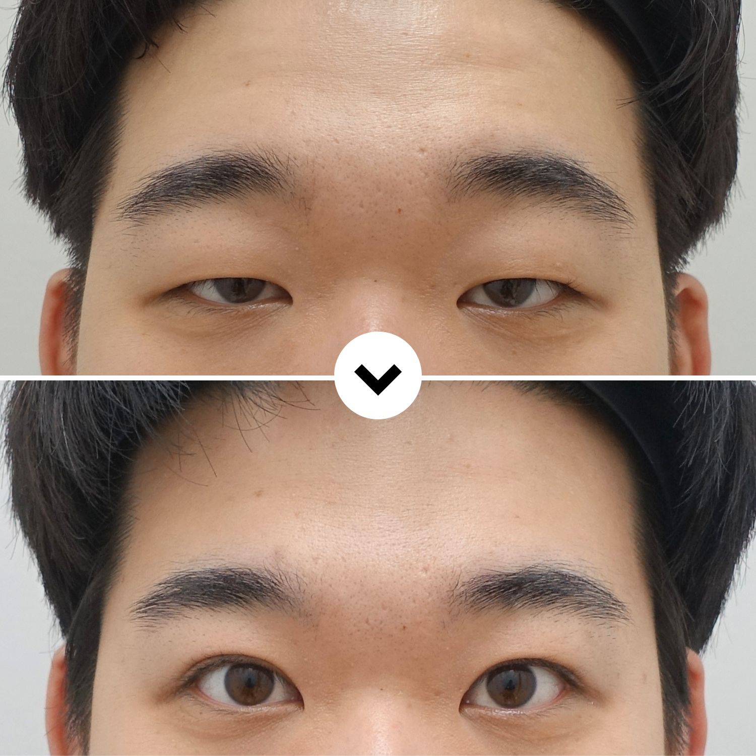 Before and after ptosis correction surgery in Korea showing improved eyelid opening and natural eye symmetry