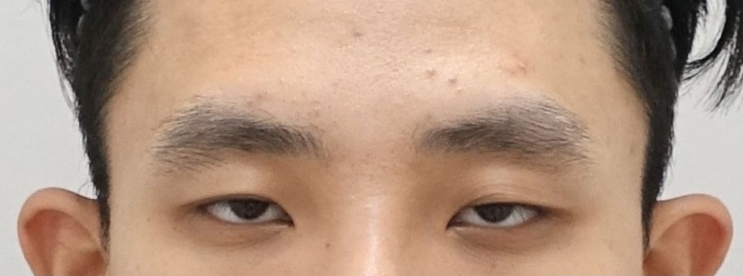 Ptosis Before Surgery – Eyelid Drooping Case in Korea