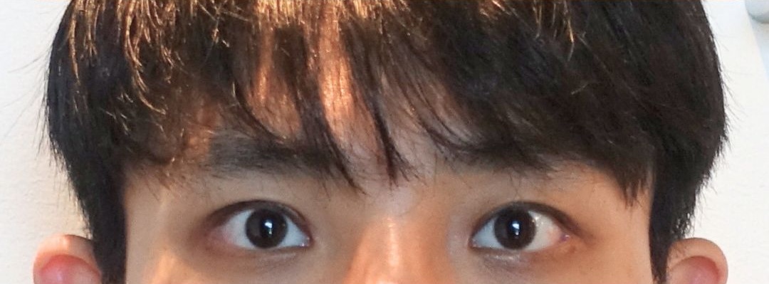 ptosis correction after 60 days improved eyelid opening korea