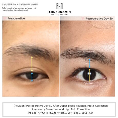 When a High Fold Should Be Lowered—and When It Should Not.