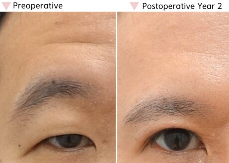 Why Your Eyes Feel Heavier After Forehead Botox (It’s Not What You Think)