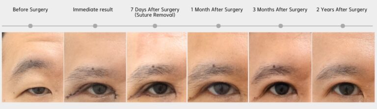 Timeline of ptosis correction recovery showing gradual improvement in eyelid opening and reduction of forehead compensation from before surgery to postoperative year 2