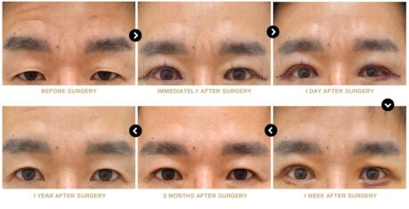 Why One Eye Looks Smaller After Ptosis Surgery.