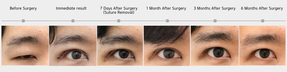 Ptosis correction recovery timeline showing eyelid opening improvement from before surgery to 6 months after surgery in Korea.