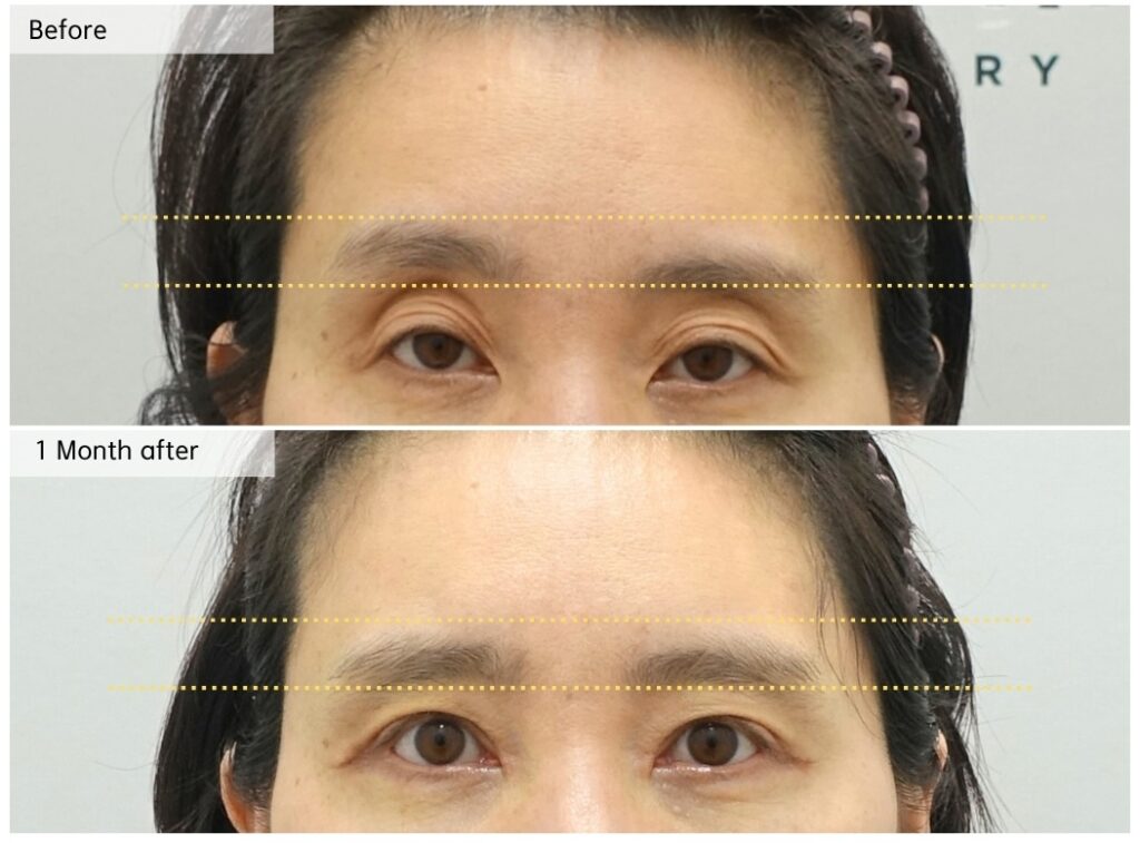 ptosis correction before and after showing improved eye opening and balanced brow position at 1 month