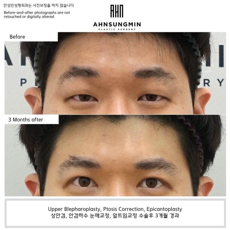 Before and 3 months after ptosis correction showing reduced eyebrow compensation and improved natural eyelid opening.