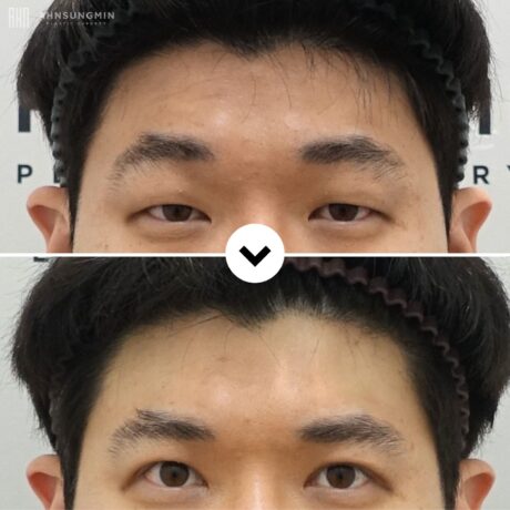 Ptosis Surgery: Why Patients Raise Their Eyebrows When Ptosis Is Present