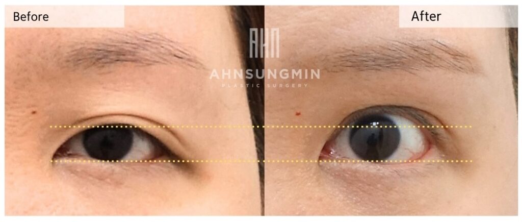 ptosis eyelid opening weakness high fold heavy eyes after double eyelid surgery