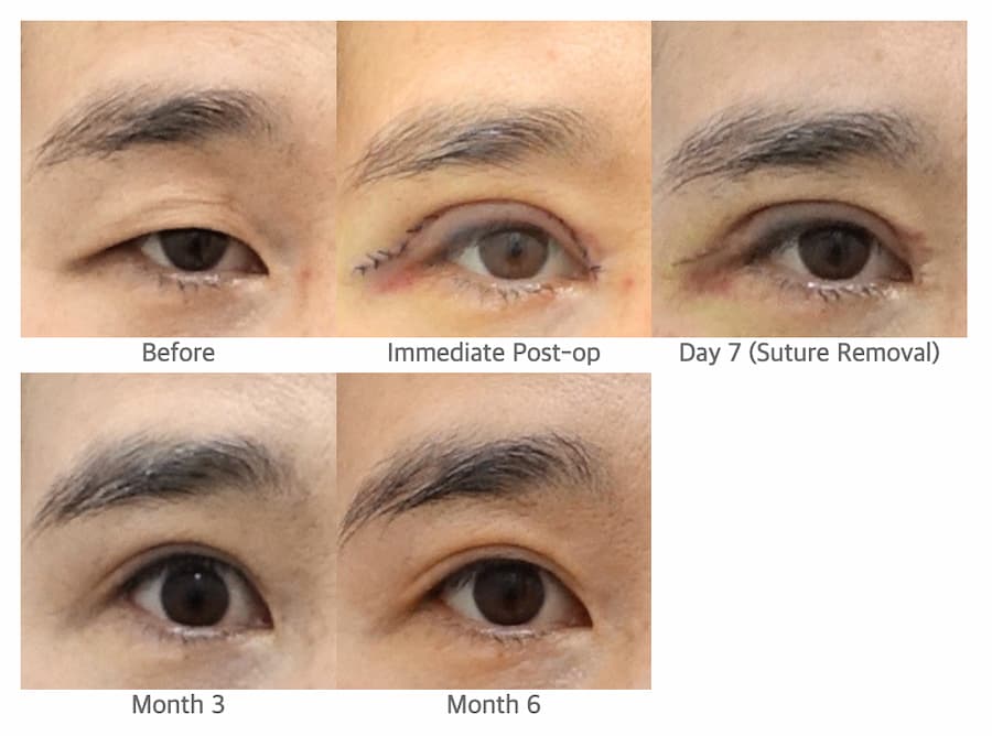 ptosis surgery recovery stages showing before, immediate postoperative, day 7, month 3, and natural eyelid result at month 6