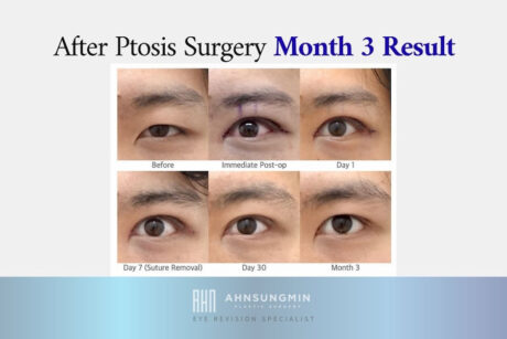 Ptosis Surgery Recovery Timeline: What to Expect From Day 1 to Month 3.