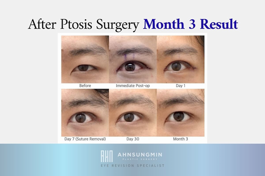 Ptosis Surgery Recovery Timeline: What to Expect From Day 1 to Month 3.