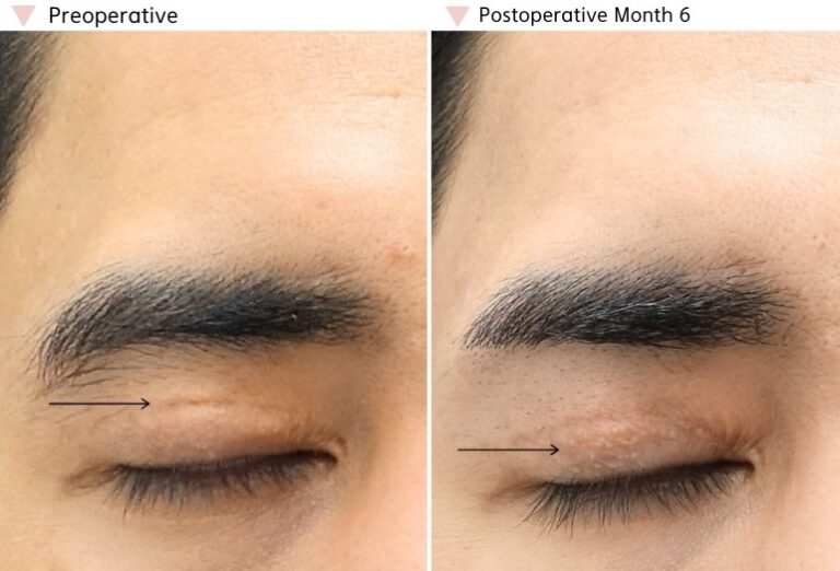 Upper eyelid incision scar before and 6 months after ptosis revision surgery showing a well-healed eyelid crease and stable recovery.