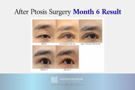When Does Ptosis Surgery Look Natural? Understanding the 6-Month Recovery Point
