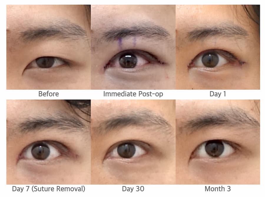 ptosis surgery recovery stages showing before, immediate postoperative, day 1, day 7, day 30, and 3 months results