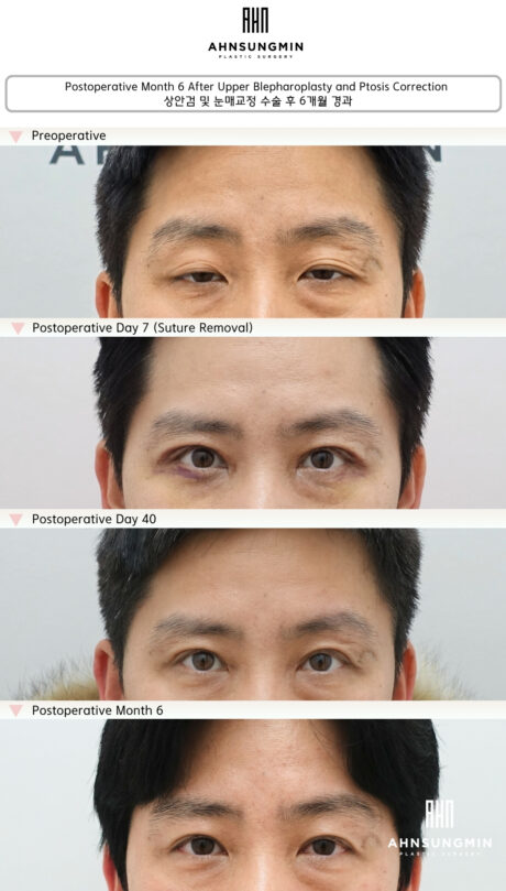 Ptosis Surgery Recovery Timeline: What to Expect After Surgery.