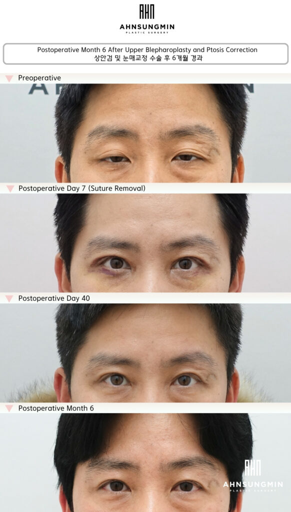 Ptosis surgery recovery timeline showing preoperative, day 7, day 40, and 6 months results