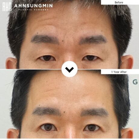 Why Do Eyes Look Uneven After Ptosis Surgery? (Recovery Explained)