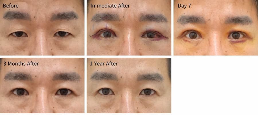ptosis surgery uneven eyes recovery showing before immediate postoperative day 7 3 months and 1 year results with gradual eyelid symmetry improvement