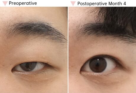 Ptosis vs. Double Eyelid Surgery: What’s the Difference?