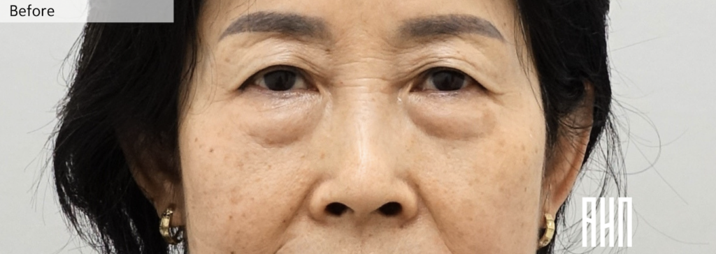 Recurrent lower eyelid bulging before revision lower eyelid surgery