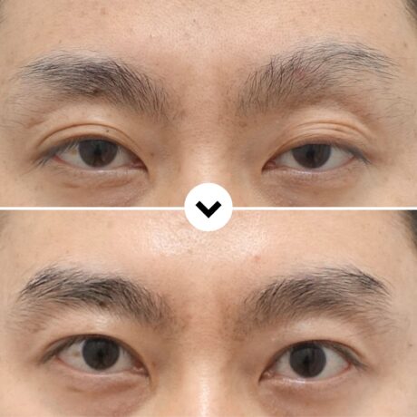 Residual Ptosis After Previous Eyelid Surgery: A Functional Revision Case