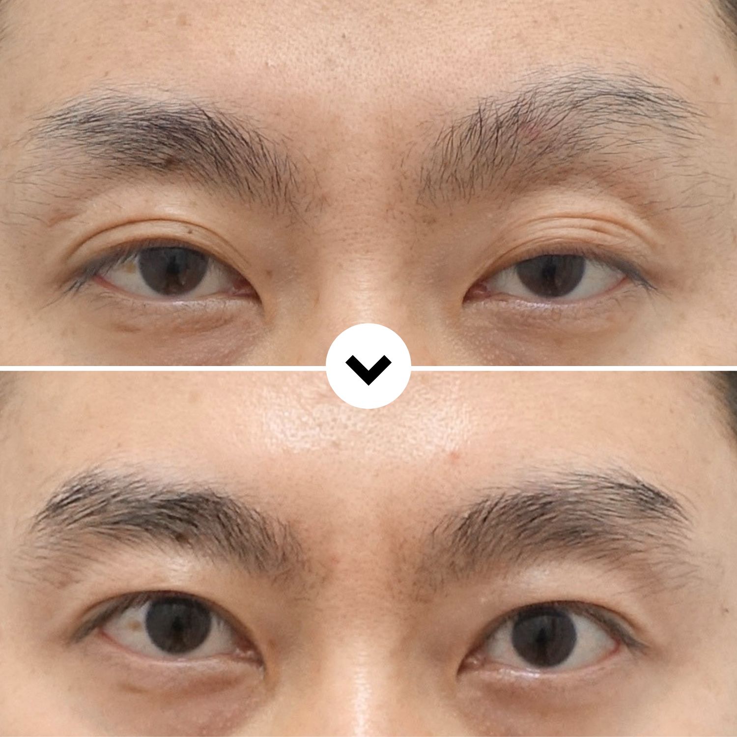 Before and after revision eyelid surgery for residual ptosis showing improved eyelid opening and a more natural upper eyelid position.