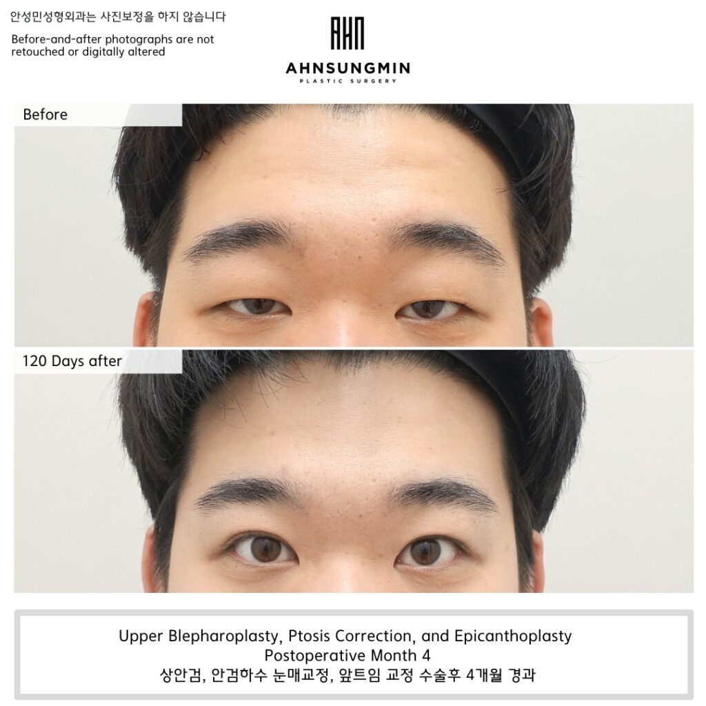 ptosis correction korea before after eyelid opening 4 months