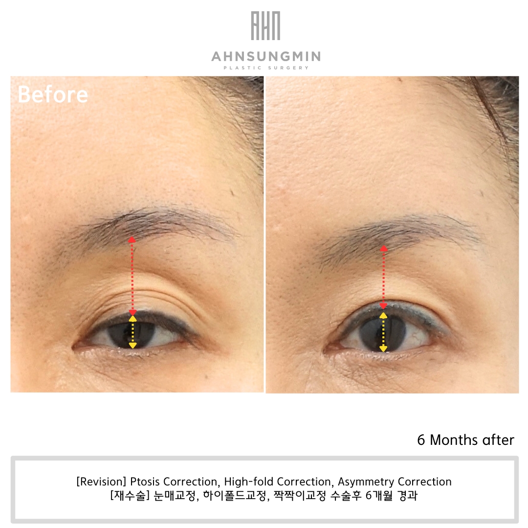 Eyelids Fold アイリッドフォールド　美容 Multiple Eyelid Folds After Double Eyelid Surgery: Causes and
