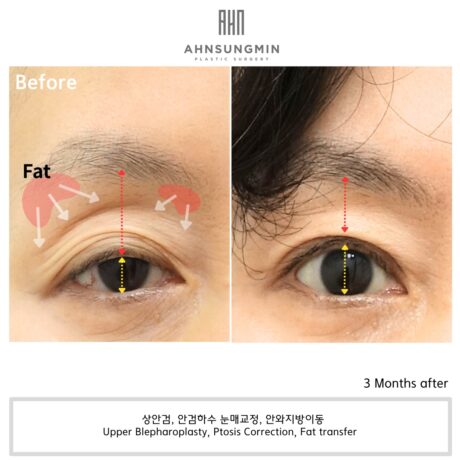what to do when your eyelids are sunken?