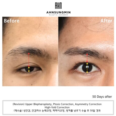 Thick Double Eyelid Creases Are Often Caused by Ptosis