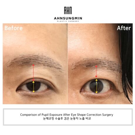Why Ptosis Correction Was Necessary and the Crease Was Lowered.