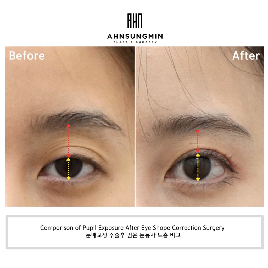Comparison of Pupil Exposure After Eye Shape Correction Surgery