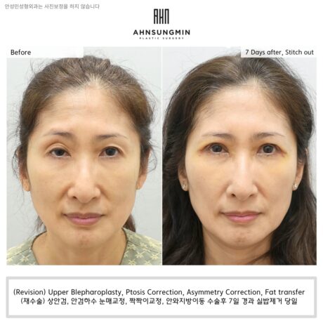 [Revision Surgery] The reasons why you should not correct only one eyelid for uneven ptosis.