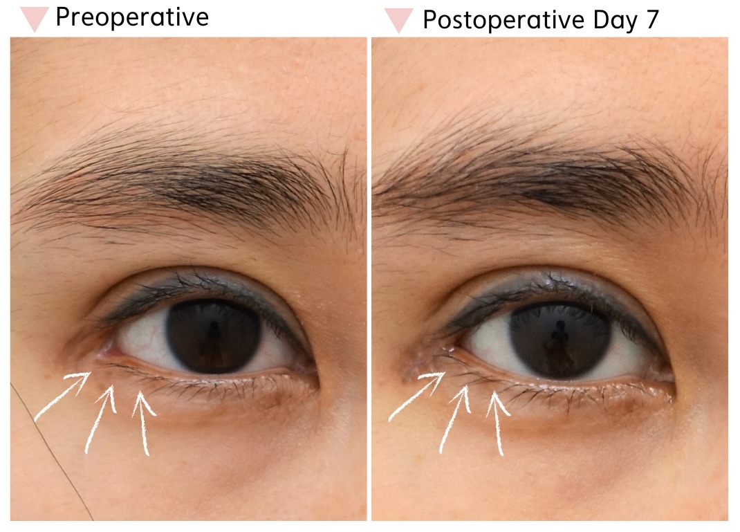Preoperative and postoperative day 7 comparison after canthoplasty restoration surgery showing reconstruction of the lower outer corner contour and improved eyelid continuity