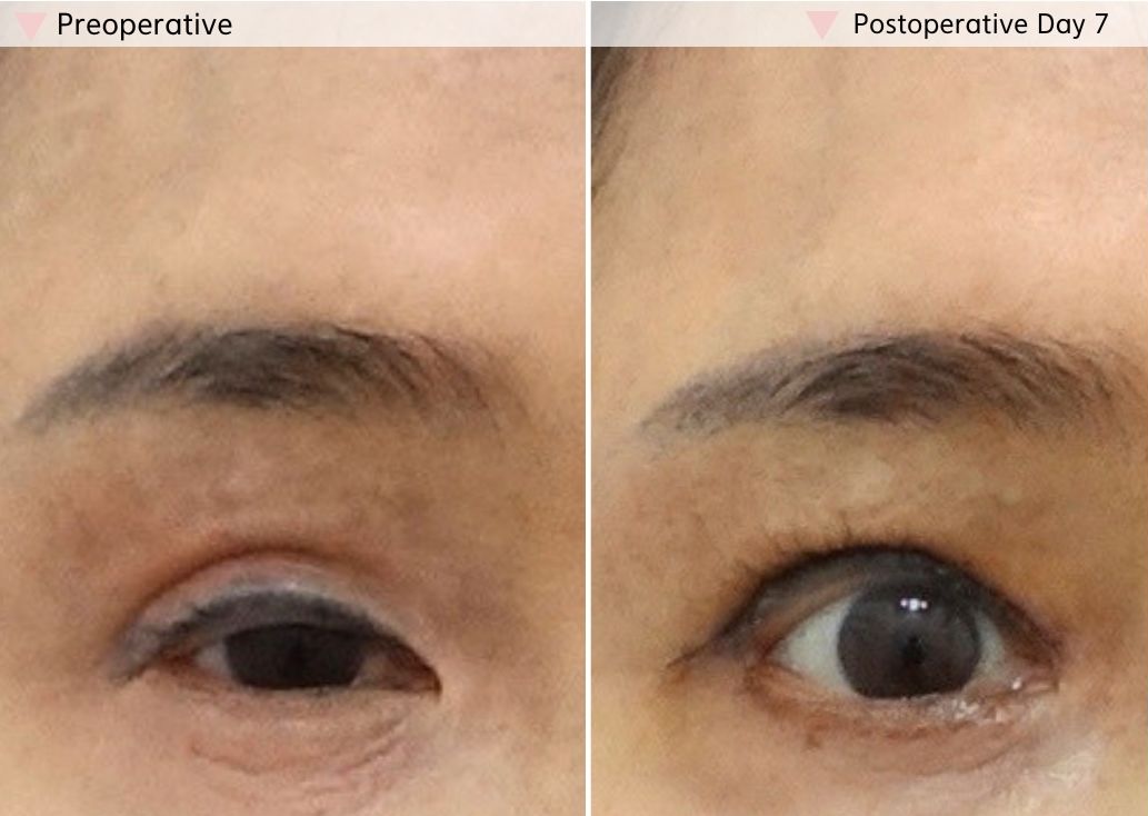 Revision eyelid surgery before and after in Korea