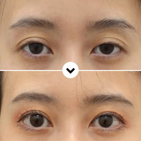 How Long Should You Wait Before Revision Eyelid Surgery?