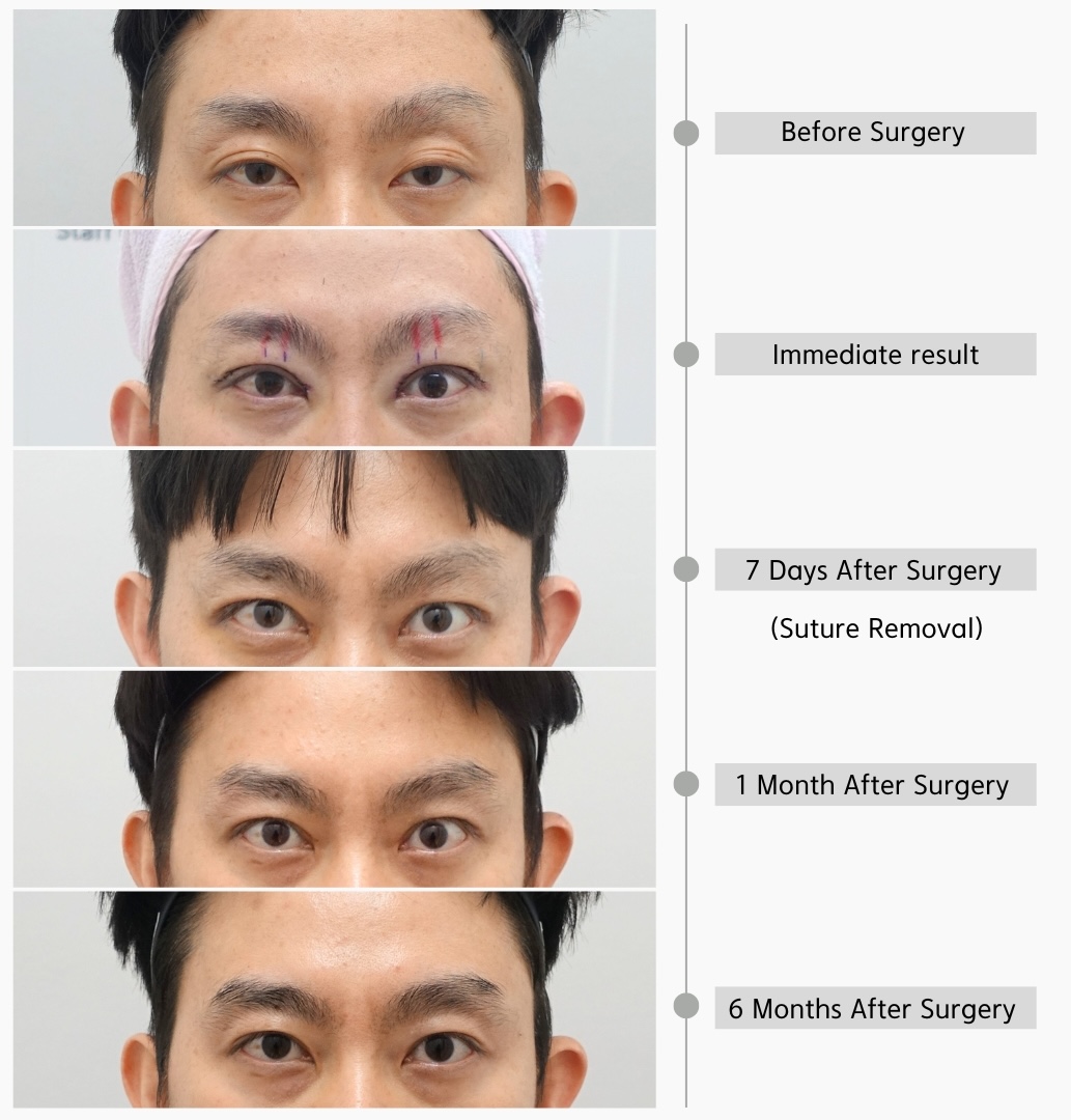 Revision Ptosis Surgery Recovery Timeline from Before Surgery to 6 Months After Surgery