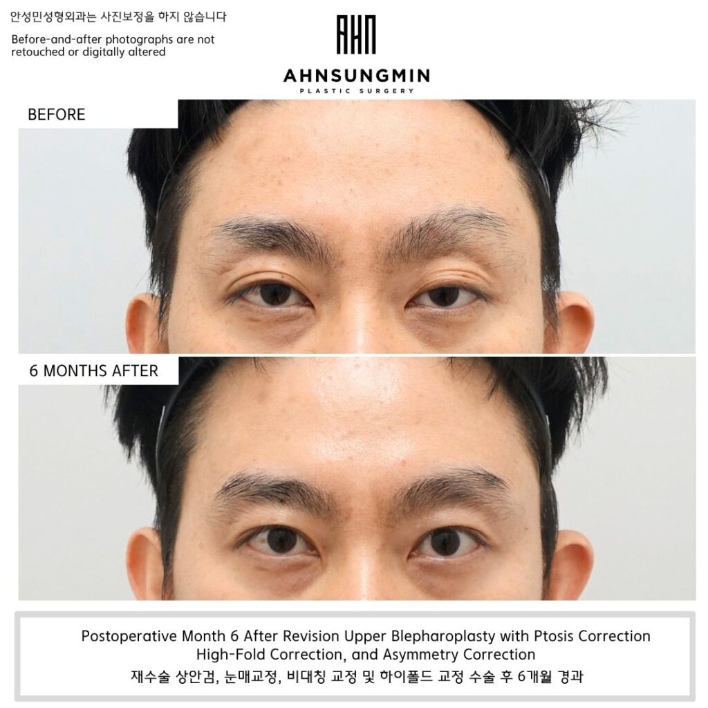 revision high fold eyelid with ptosis correction male before and after 6 months