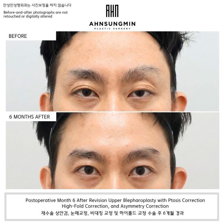revision high fold eyelid with ptosis correction male before and after 6 months