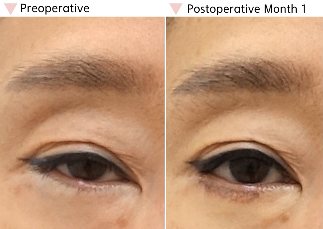 Preoperative and postoperative month 1 comparison after revision lateral canthoplasty showing improved horizontal eye length and outer corner stability