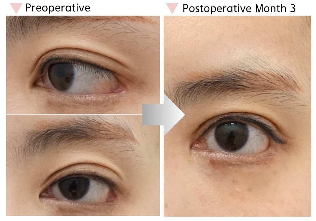 Preoperative and postoperative month 3 comparison showing restoration of eye shape and horizontal eye length after revision lateral canthoplasty