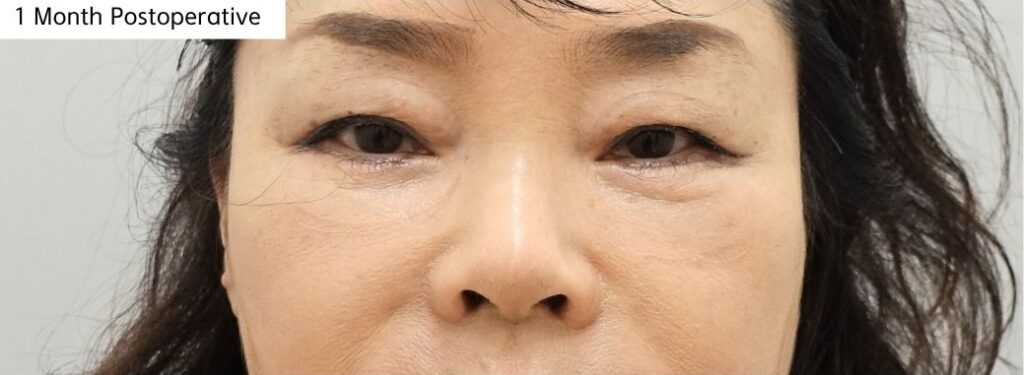 1 month recovery after revision lower blepharoplasty in Korea