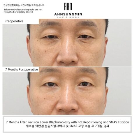 Why Fat Removal Can Lead to Recurrence After Lower Eyelid Surgery.
