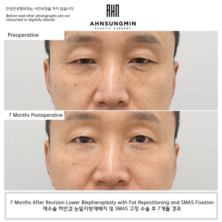 Revision lower blepharoplasty with fat repositioning and SMAS fixation before and 7 months after surgery in Korea