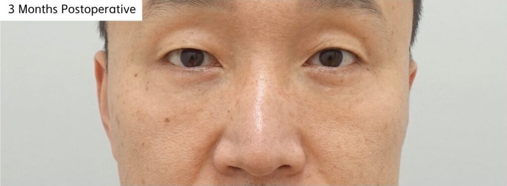 3-month recovery after revision lower blepharoplasty with fat repositioning