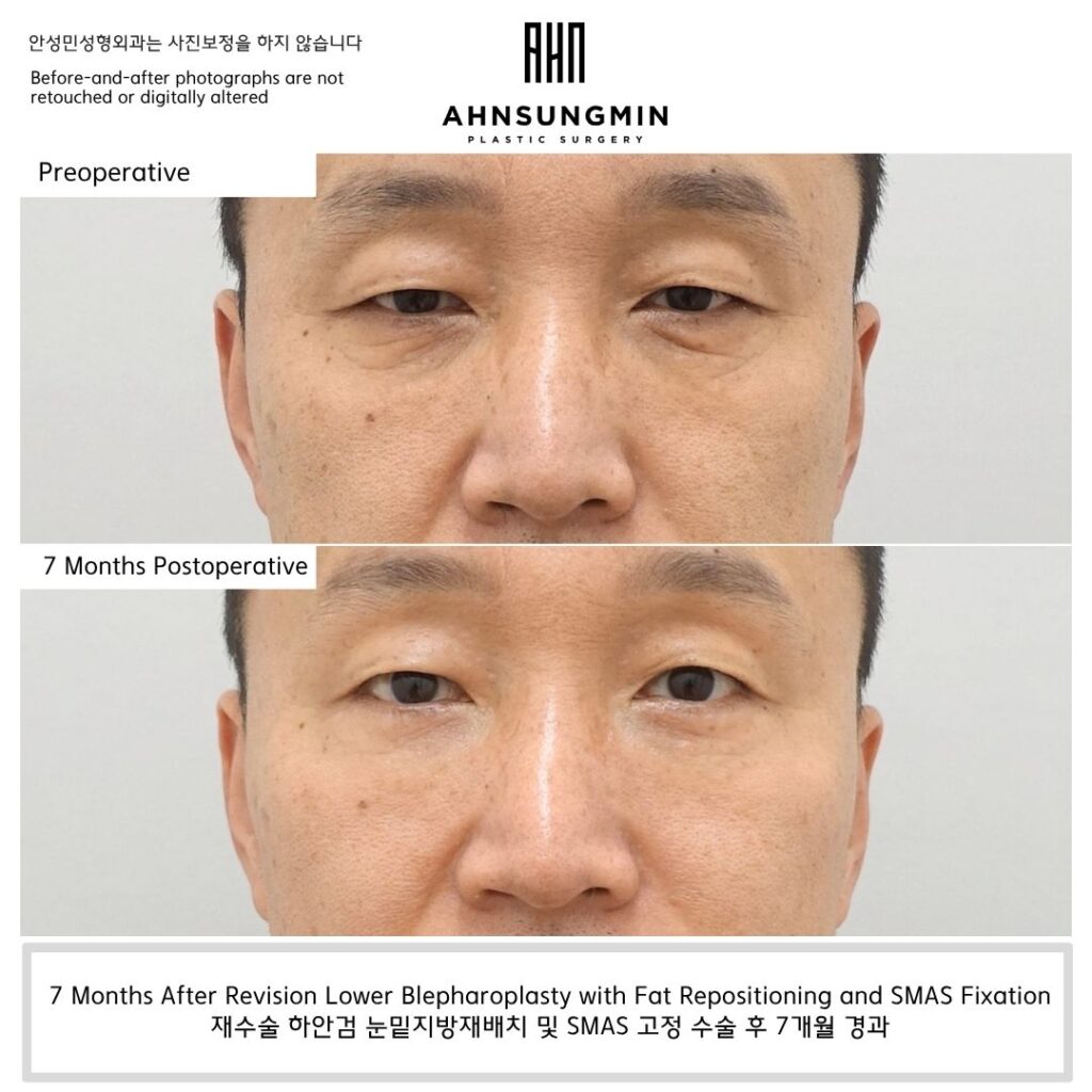 7-month result after revision lower blepharoplasty with fat repositioning and SMAS fixation in Korea