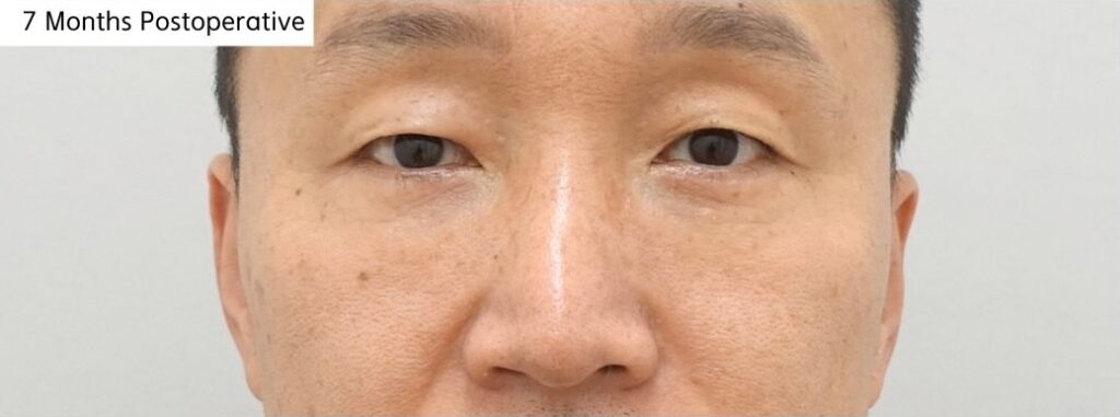 7 months after revision lower blepharoplasty surgery in Korea