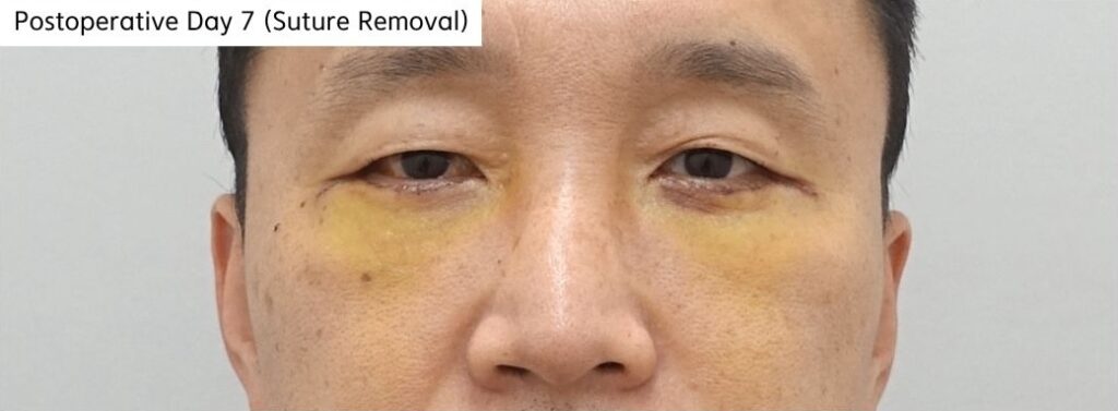 Postoperative day 7 recovery after revision lower blepharoplasty in Korea